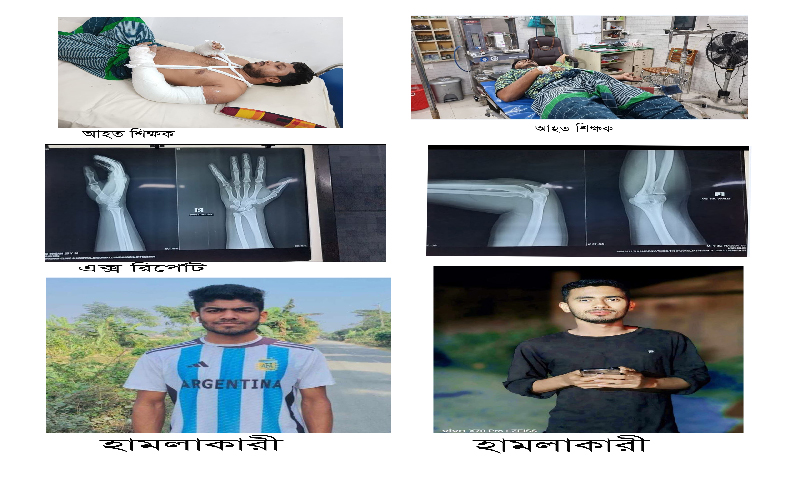 ইভটিজিংয়ের প্রতিবাদ করায় শিক্ষকের দুই হাত ভেঙ্গে দিল কিশোর গ্যাং